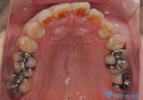 [40代男性・受け口] 下のみ抜歯の矯正治療の治療前