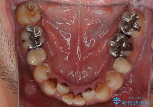[40代男性・受け口] 下のみ抜歯の矯正治療の治療前
