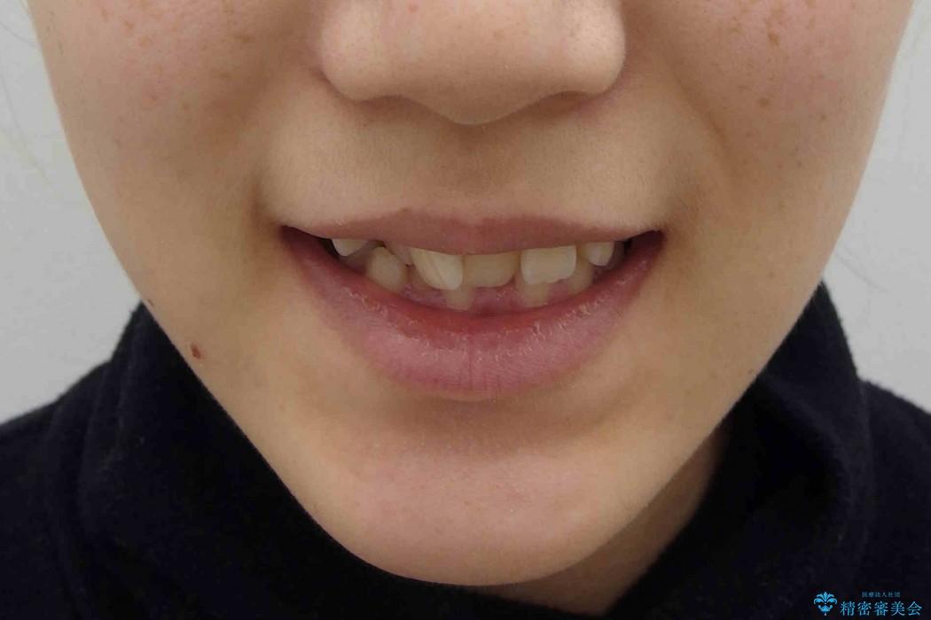 [正中のずれ・前歯のがたがた] 上だけ抜歯で矯正治療の治療前（顔貌）