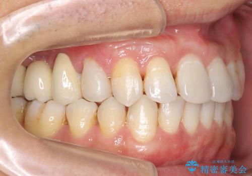 [30代男性　受け口] 歯を抜かない矯正治療の治療後