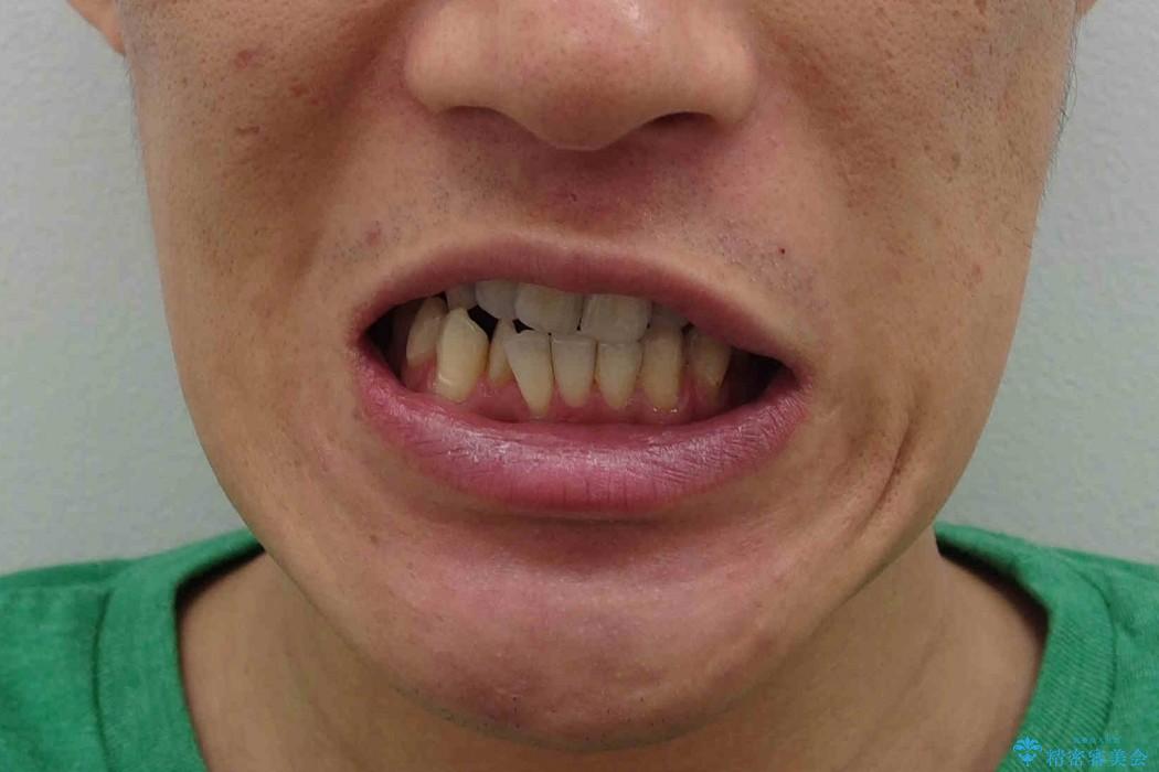 [30代男性　受け口] 歯を抜かない矯正治療の治療前（顔貌）