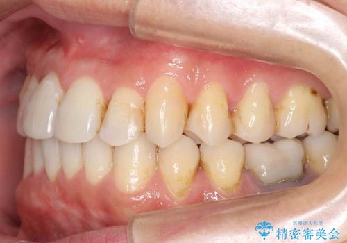 [30代男性　受け口] 歯を抜かない矯正治療の治療後
