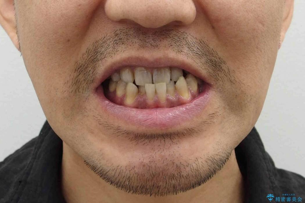 [40代男性・受け口] 下のみ抜歯の矯正治療の治療前（顔貌）