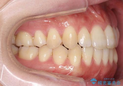 [軽度叢生と臼歯の反対咬合] 歯を抜かない矯正治療の治療後