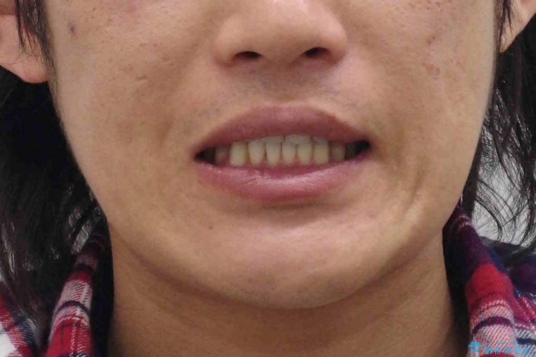 [30代男性　受け口] 歯を抜かない矯正治療の治療後（顔貌）