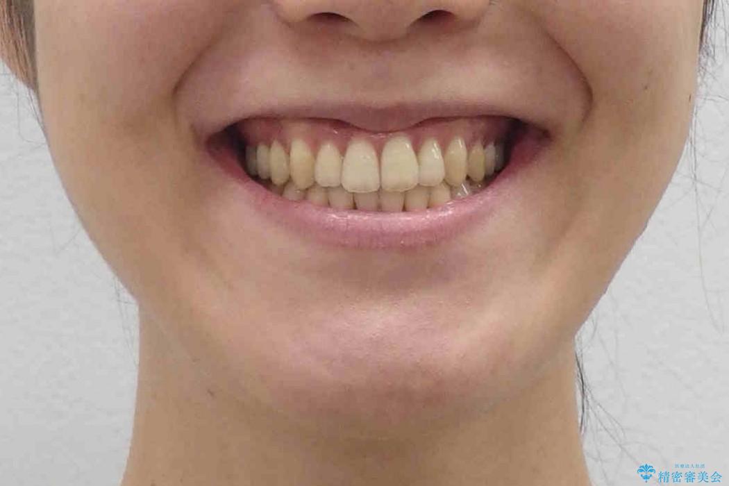[軽度叢生と臼歯の反対咬合] 歯を抜かない矯正治療の治療後（顔貌）