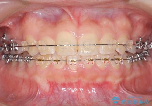 [正中のずれ・前歯のがたがた] 上だけ抜歯で矯正治療の治療中