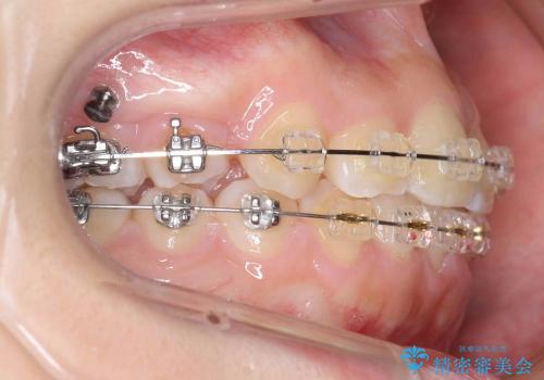 [正中のずれ・前歯のがたがた] 上だけ抜歯で矯正治療の治療中