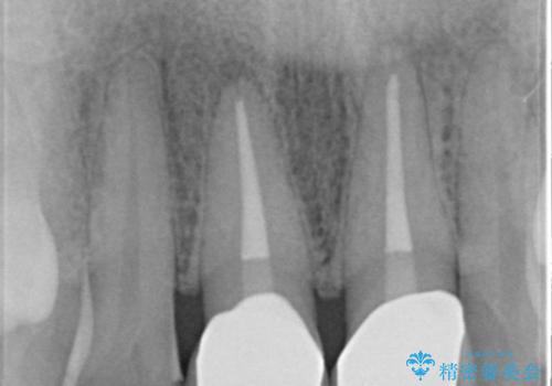 [顕微鏡治療]  前歯部精密審美オールセラミック治療の治療後