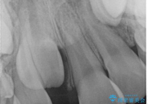 [小児・過剰歯] 埋まっている余分な歯を抜歯の治療後