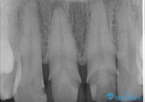 [顕微鏡治療]  前歯部精密審美オールセラミック治療の治療前