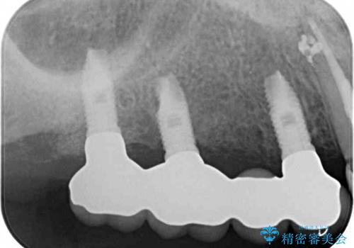 奥歯が痛い　インプラントによる奥歯の治療の治療後