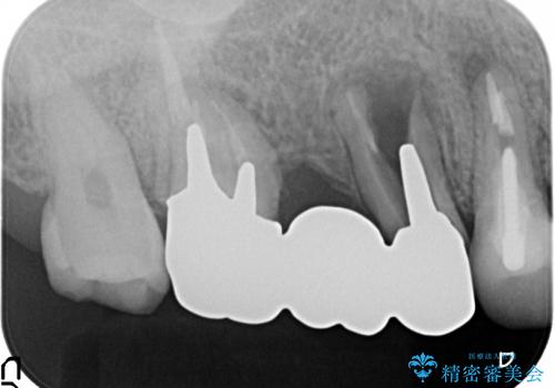 奥歯が痛い　インプラントによる奥歯の治療の治療前
