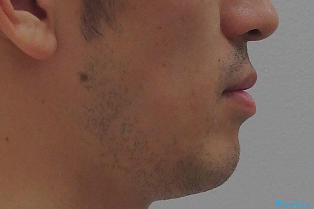 [30代男性 受け口 オペケース] 顎の手術を回避 歯を抜かない矯正の治療後（顔貌）