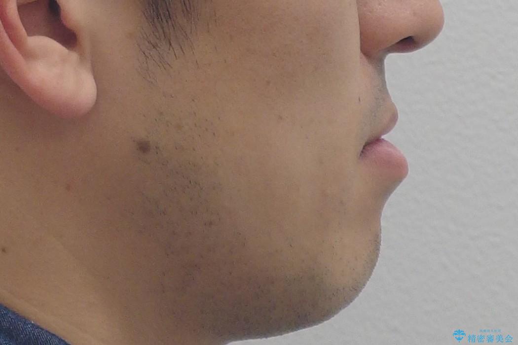 [30代男性 受け口 オペケース] 顎の手術を回避 歯を抜かない矯正の治療前（顔貌）