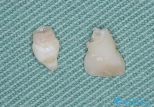 [小児・過剰歯] 埋まっている余分な歯を抜歯の治療中