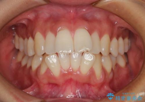 出っ歯と口元の改善の治療前