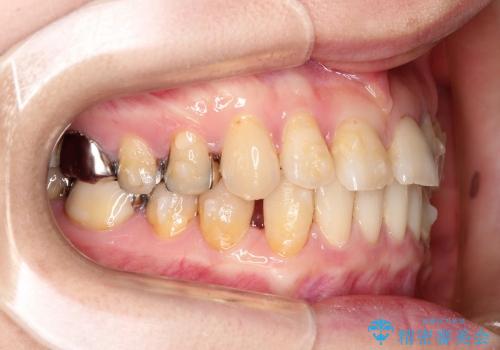 すきっ歯と上唇小帯 / インビザライン治療の治療中