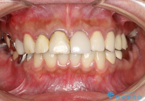 奥歯が痛い　インプラントによる奥歯の治療の治療前