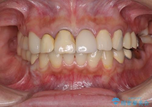 奥歯が痛い　インプラントによる奥歯の治療の治療後
