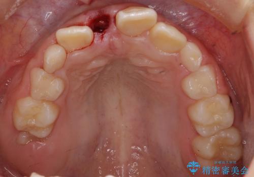 [小児・過剰歯] 埋まっている余分な歯を抜歯の治療後