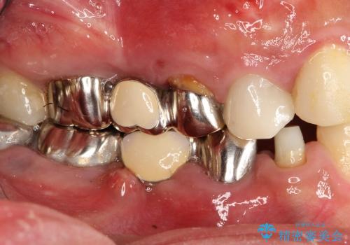 奥歯が痛い　インプラントによる奥歯の治療