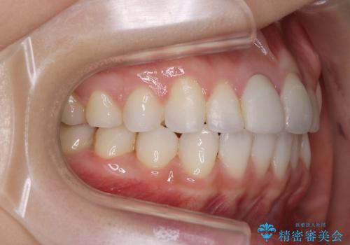 でこぼこの歯 / 上下の歯の真ん中を揃えるの治療後