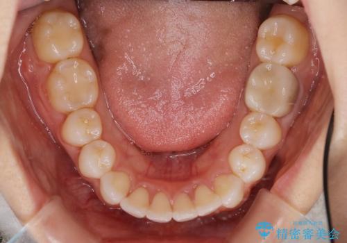 でこぼこの歯 / 上下の歯の真ん中を揃えるの治療後
