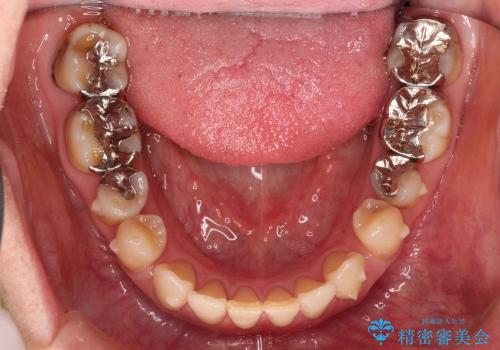 すきっ歯と上唇小帯 / インビザライン治療の治療中