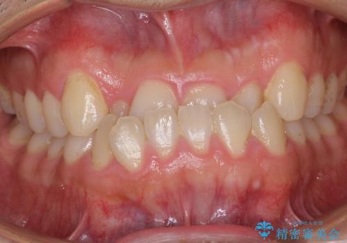 [30代男性 受け口 オペケース] 顎の手術を回避 歯を抜かない矯正の治療前
