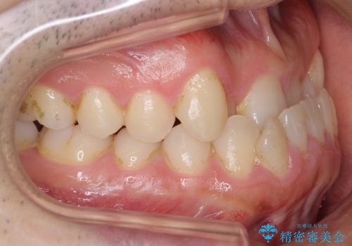 [30代男性 受け口 オペケース] 顎の手術を回避 歯を抜かない矯正の治療前