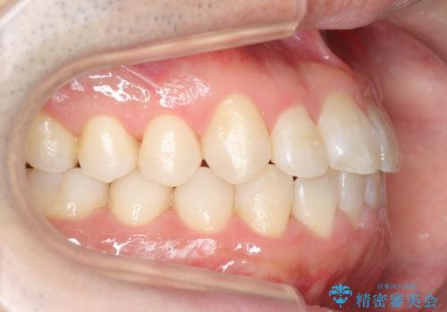 [30代男性 受け口 オペケース] 顎の手術を回避 歯を抜かない矯正の治療後