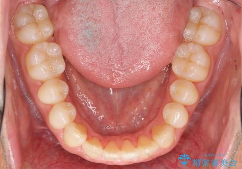 [30代男性 受け口 オペケース] 顎の手術を回避 歯を抜かない矯正の治療後