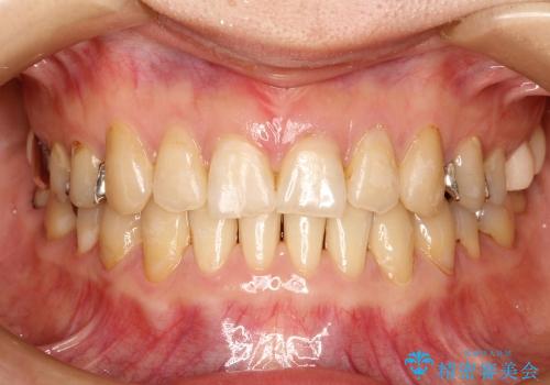 すきっ歯と上唇小帯 / インビザライン治療の治療後