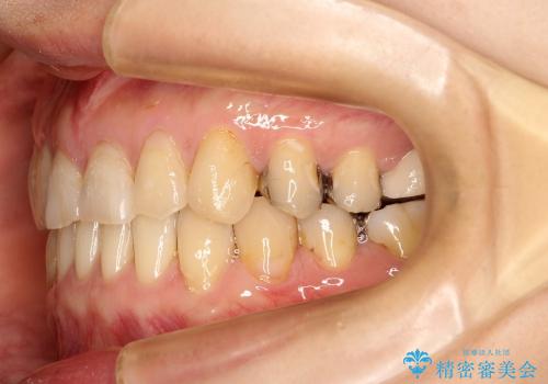 すきっ歯と上唇小帯 / インビザライン治療の治療後