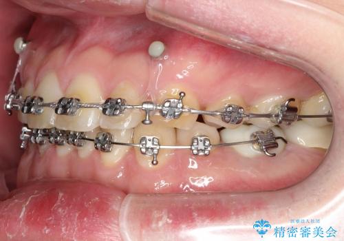 セラミック治療と再矯正 / 出っ歯とすきっ歯を治したいの治療中