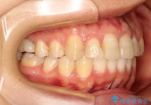 歯のでこぼこ / インビザライン治療の治療後