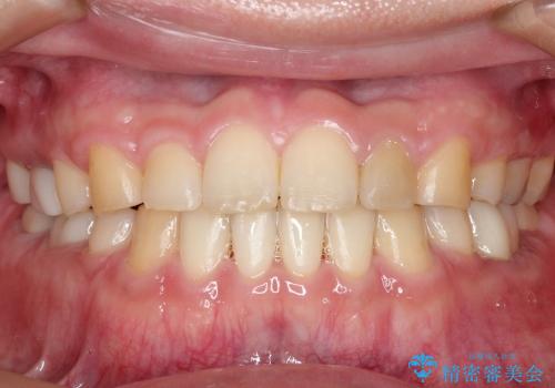 セラミック治療と再矯正 / 出っ歯とすきっ歯を治したいの治療後