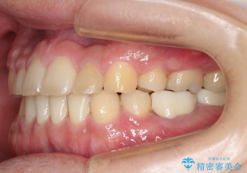 セラミック治療と再矯正 / 出っ歯とすきっ歯を治したいの治療後