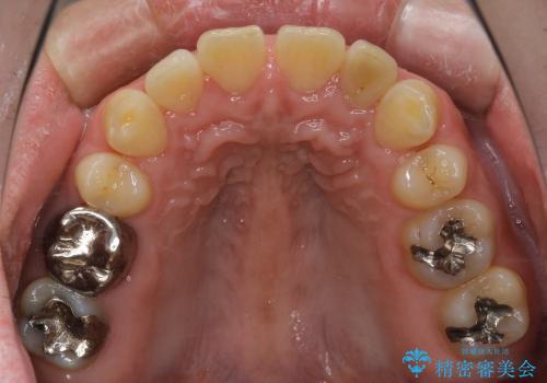 セラミック治療と再矯正 / 出っ歯とすきっ歯を治したいの治療前