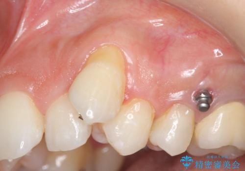 [歯ぐきの再生] 矯正治療前の歯肉移植の治療前