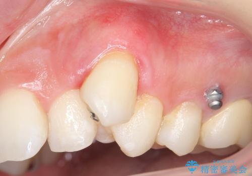 [歯ぐきの再生] 矯正治療前の歯肉移植の治療後