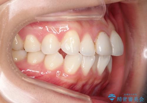 でこぼこの歯 / 上下の歯の真ん中を揃えるの治療前