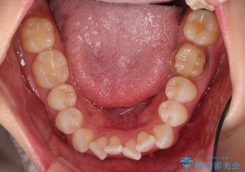 でこぼこの歯 / 上下の歯の真ん中を揃えるの治療前