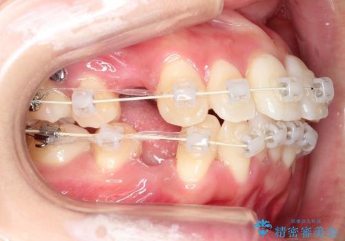 出っ歯と口元の改善の治療中