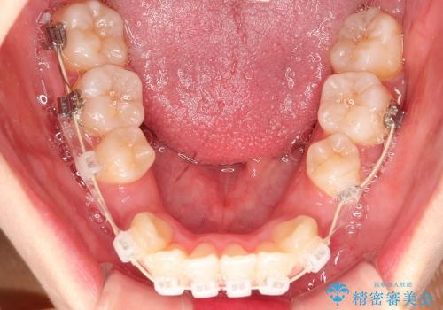 出っ歯と口元の改善の治療中