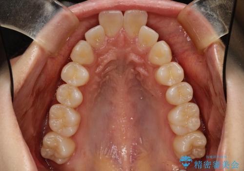 出っ歯と口元の改善の治療前
