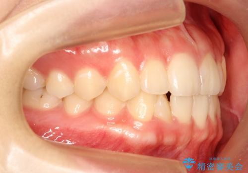 八重歯の部分矯正 / 裏側矯正の治療後