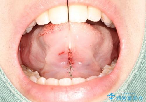 20代女性　舌小帯切除の治療後