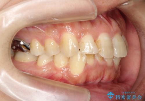 歯のでこぼこ / インビザライン治療の治療前